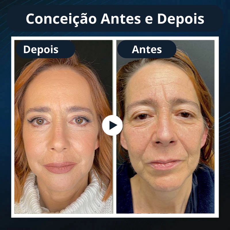 Redutor de Gordura Facial